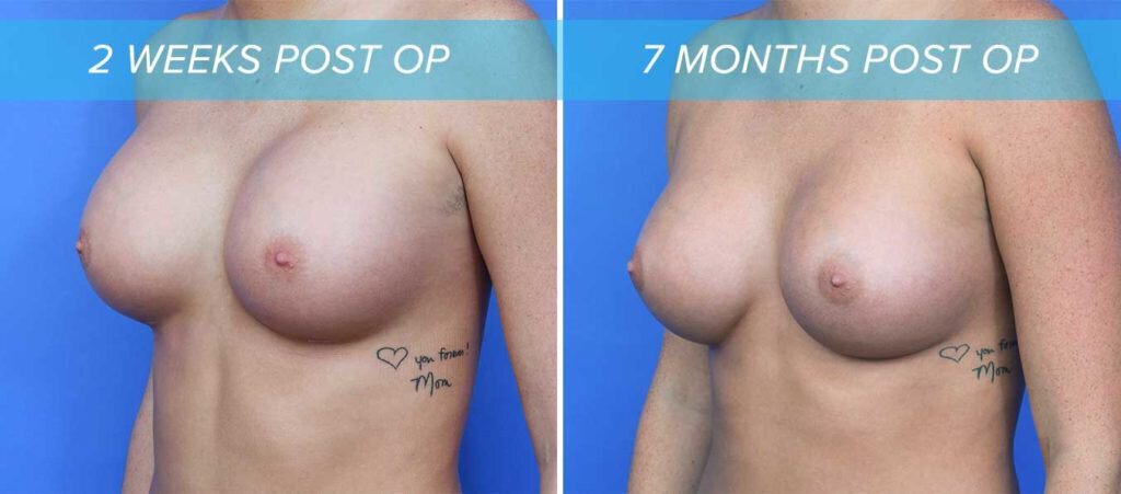 oblique view of how wearing a bra after breast augmentation can improve implant settling