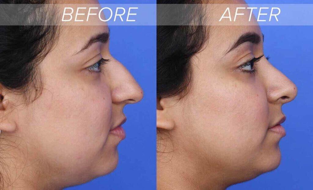 hook nose rhinoplasty before and after photos