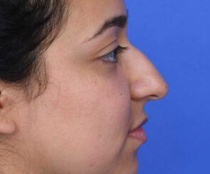 procedure photo taken before hook nose rhinoplasty