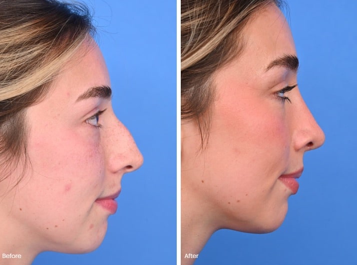 What You Need to Know About Nose Jobs and Fillers