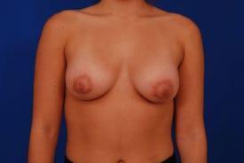 Tuberous Breasts Correction Before & After Image