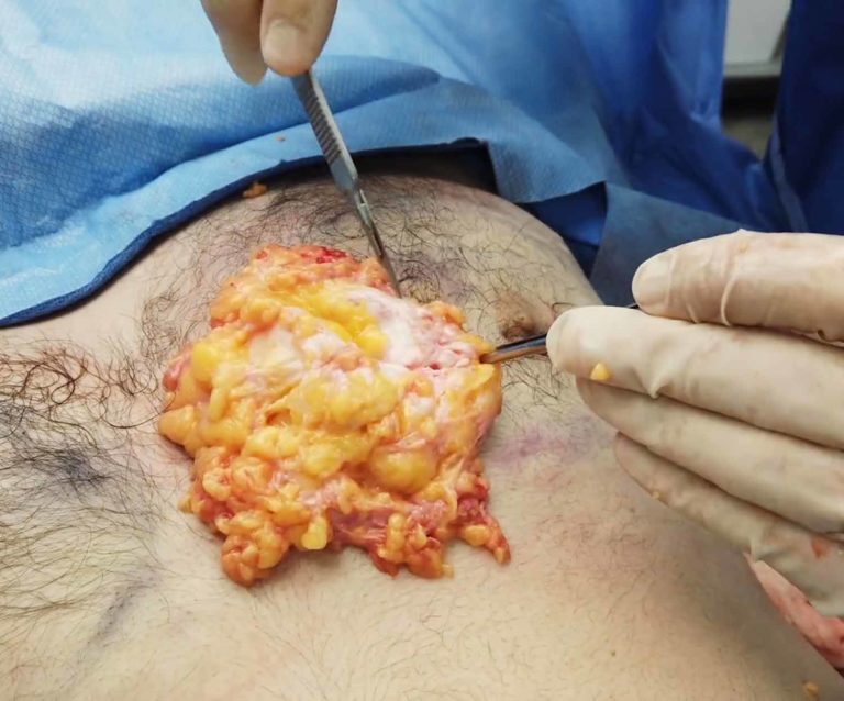 Remove all gynecomastia without caved-in nipples using the internal flap technique for gynecomastia surgery