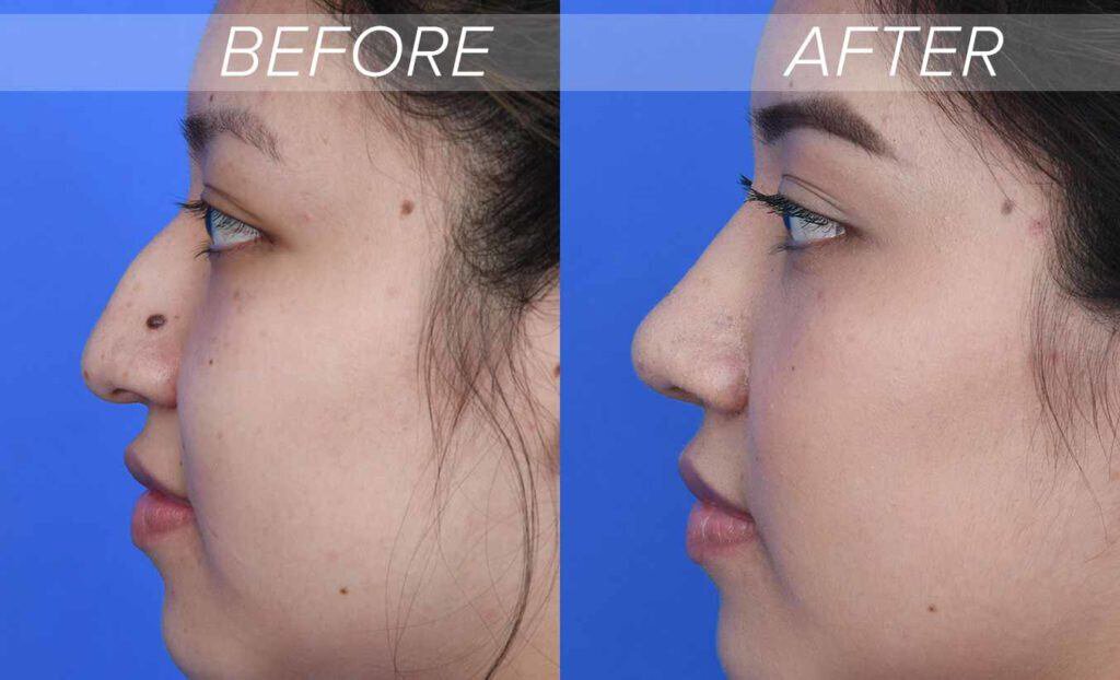 hooked nose rhinoplasty before and after photos
