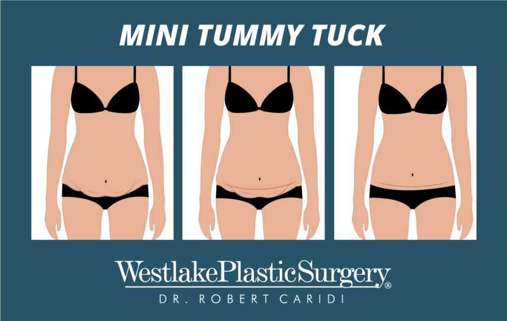 Mini Tummy Tuck Video (Mini Abdominoplasty)