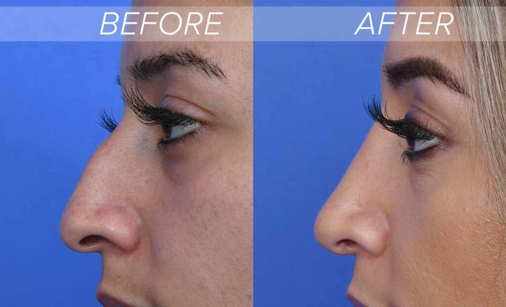 Nose job before and after photos that show successful treatment for parrot nose