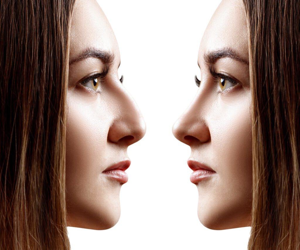 how much should a nose job cost