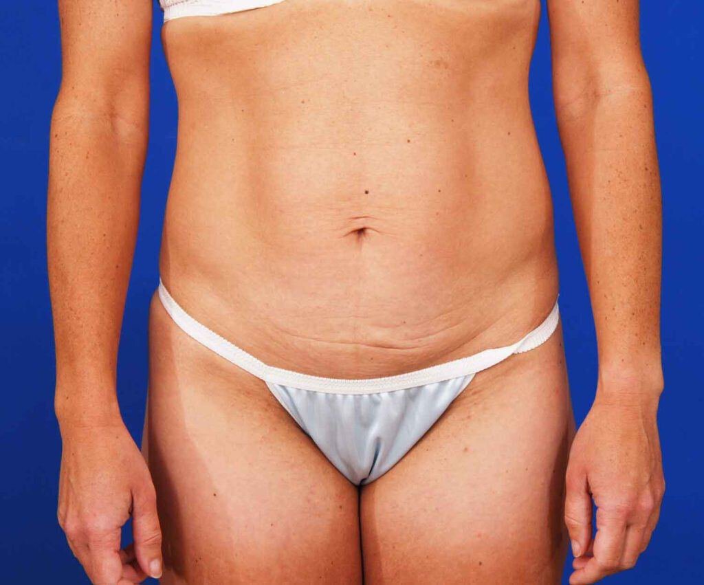 Tummy Tuck