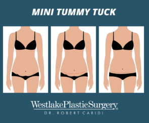 illustration showing three stages of a mini tummy tuck