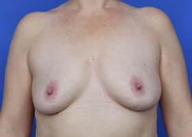 Why Breast Flat