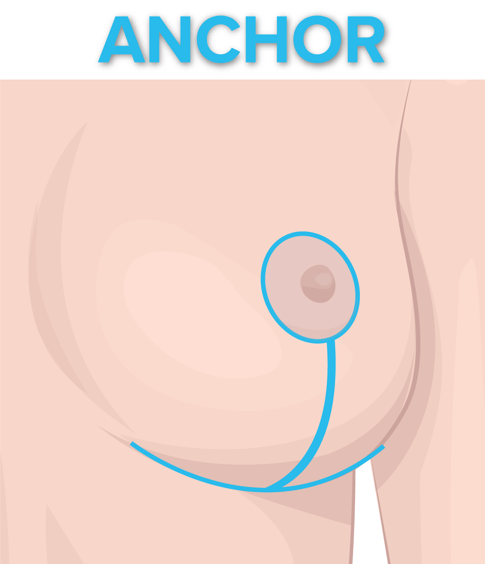 Austin breast reduction - anchor lift