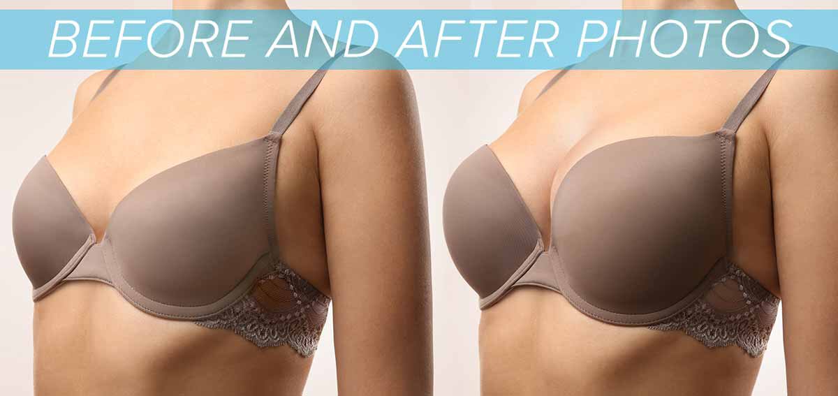 Austin breast augmentation before and after photos