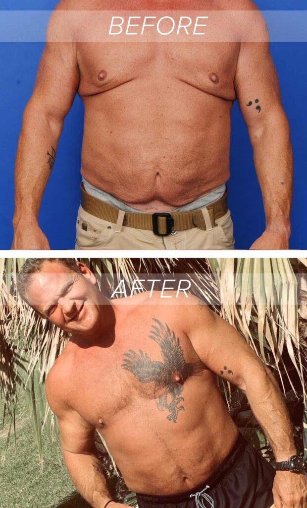 before and after photos from recent patient of the Austin Gynecomastia Center