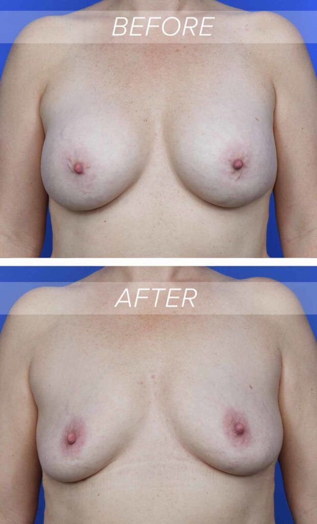 Austin breast implant removal example showing implant removal before and after photos