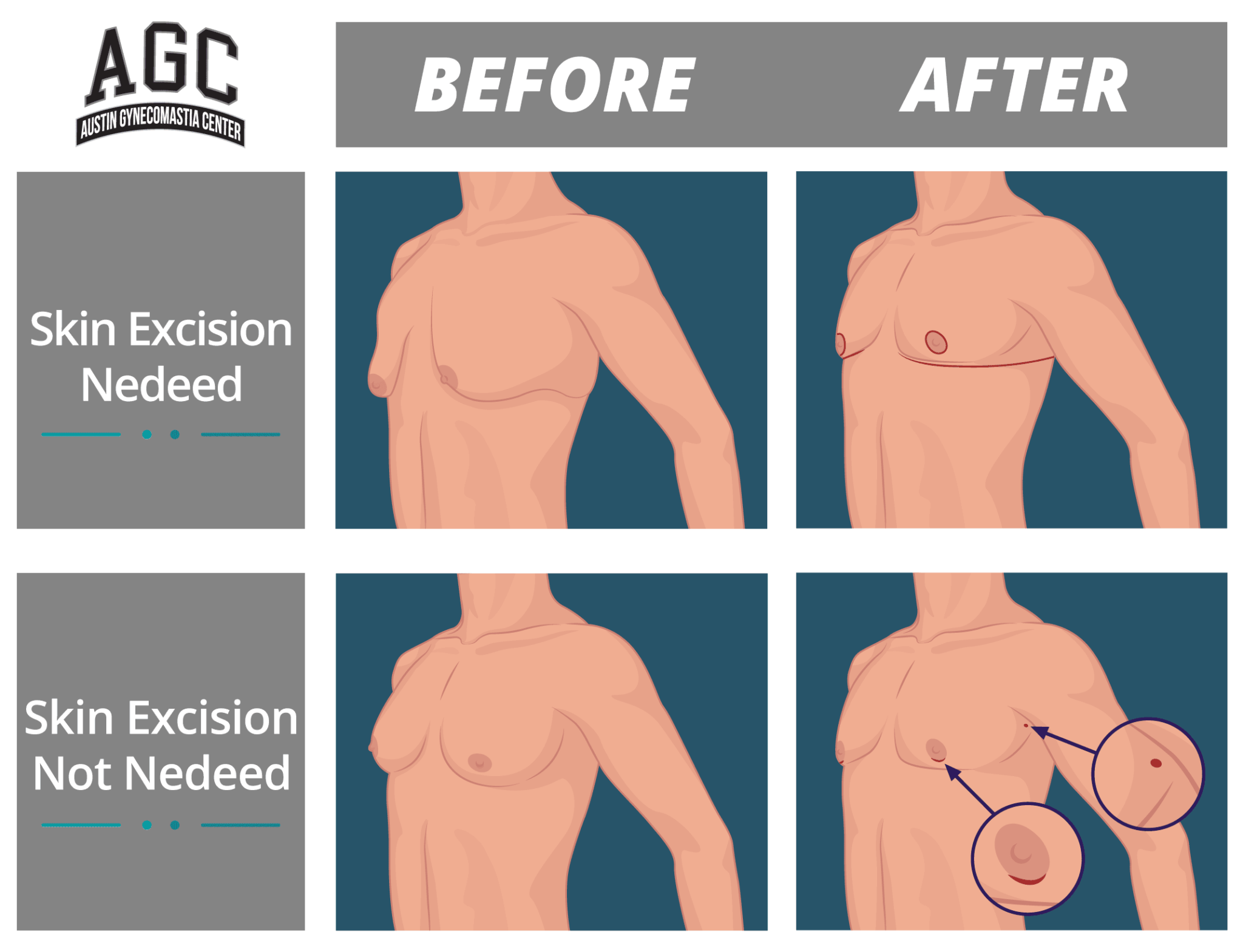 before and after photographs of a patient who had skin excision in addition to standard gynecomastia treatment