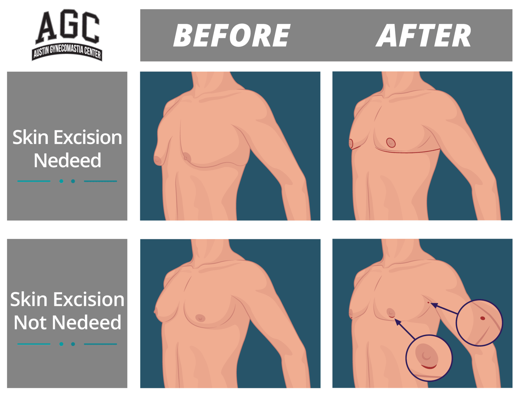 How To Tell if You Have Gynecomastia - Park Meadows Cosmetic Surgery