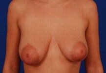 Austin Asymmetrical nipple-areola complexes patient model