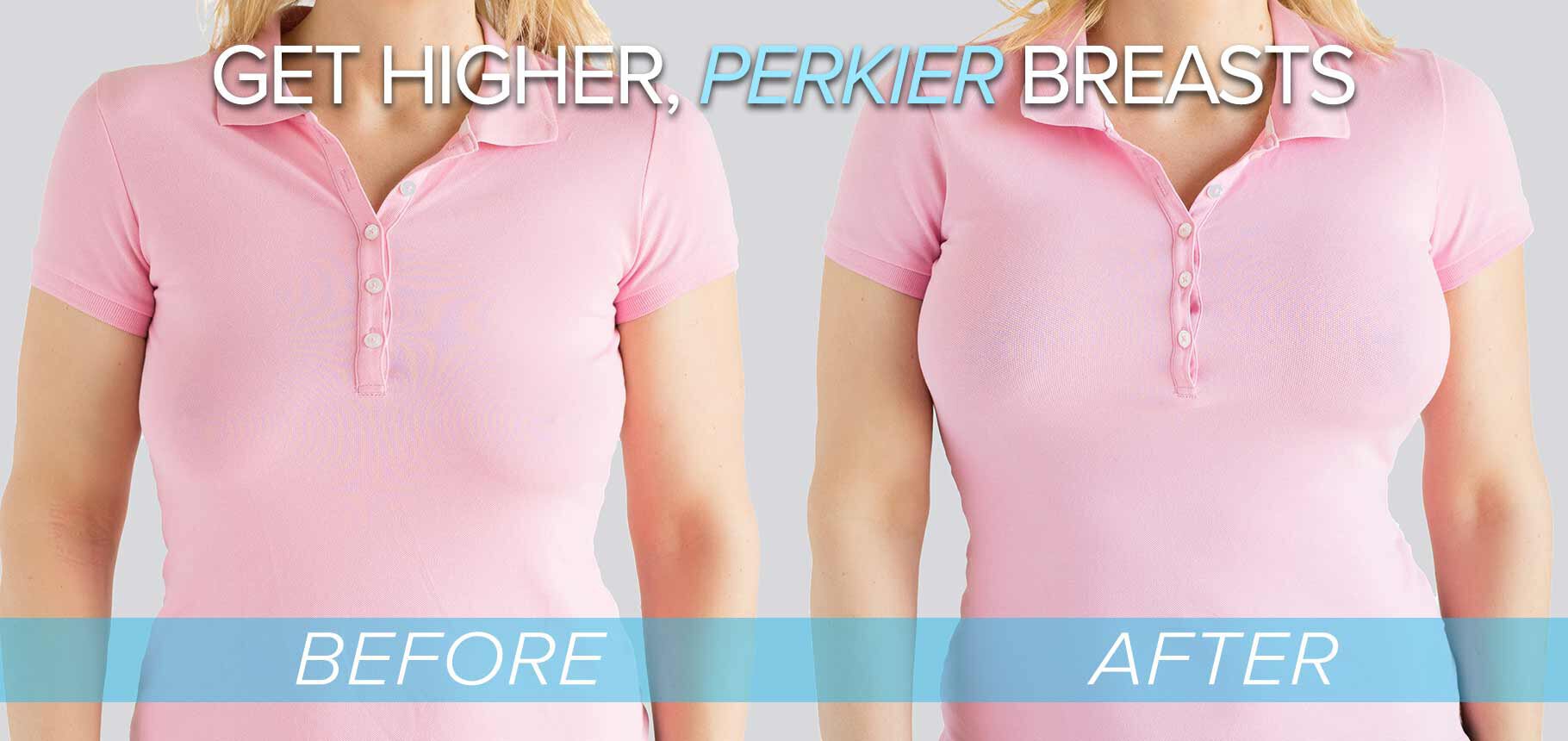 Austin breast lift with implants patient front view