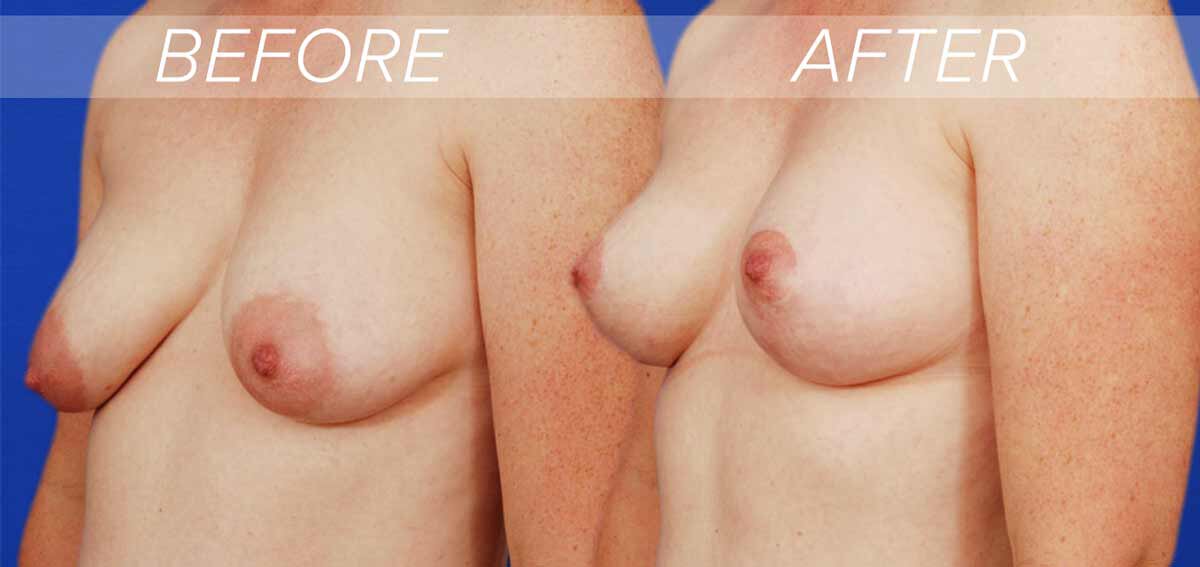 Austin breast lift patient before and after