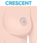 crescent lift with implants illustration