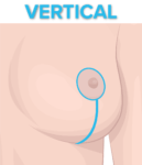 vertical lift with implants illustration