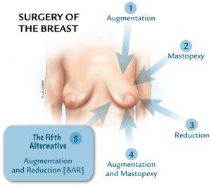Austin Breast Augmentation and Reduction Procedure - The 5th Mammaplasty Alternative - Dr. Robert Caridi