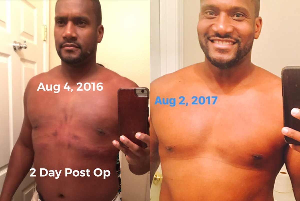 male breast reduction before and after results - patient photos two days post operative