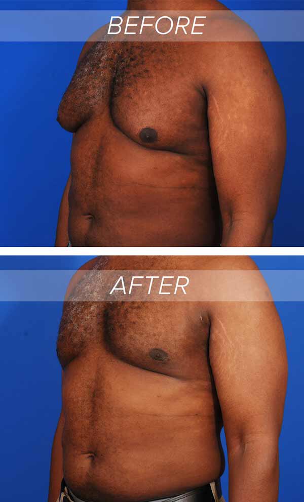 Austin gynecomastia surgery patient before and after