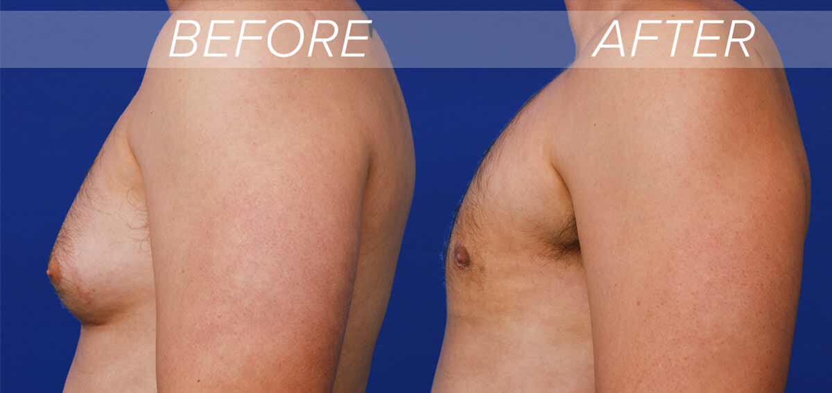 Austin gynecomastia surgery before and after results