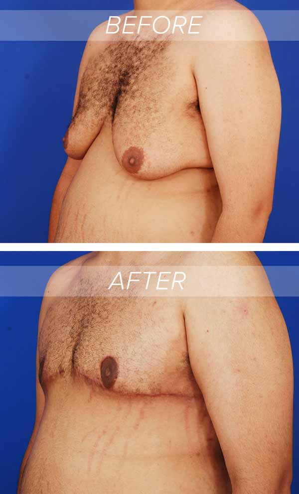 before and after photographs of a patient who had skin excision in addition to standard gynecomastia treatment