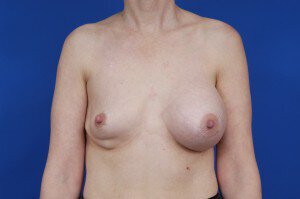 Austin Breast Implant Deflation patient
