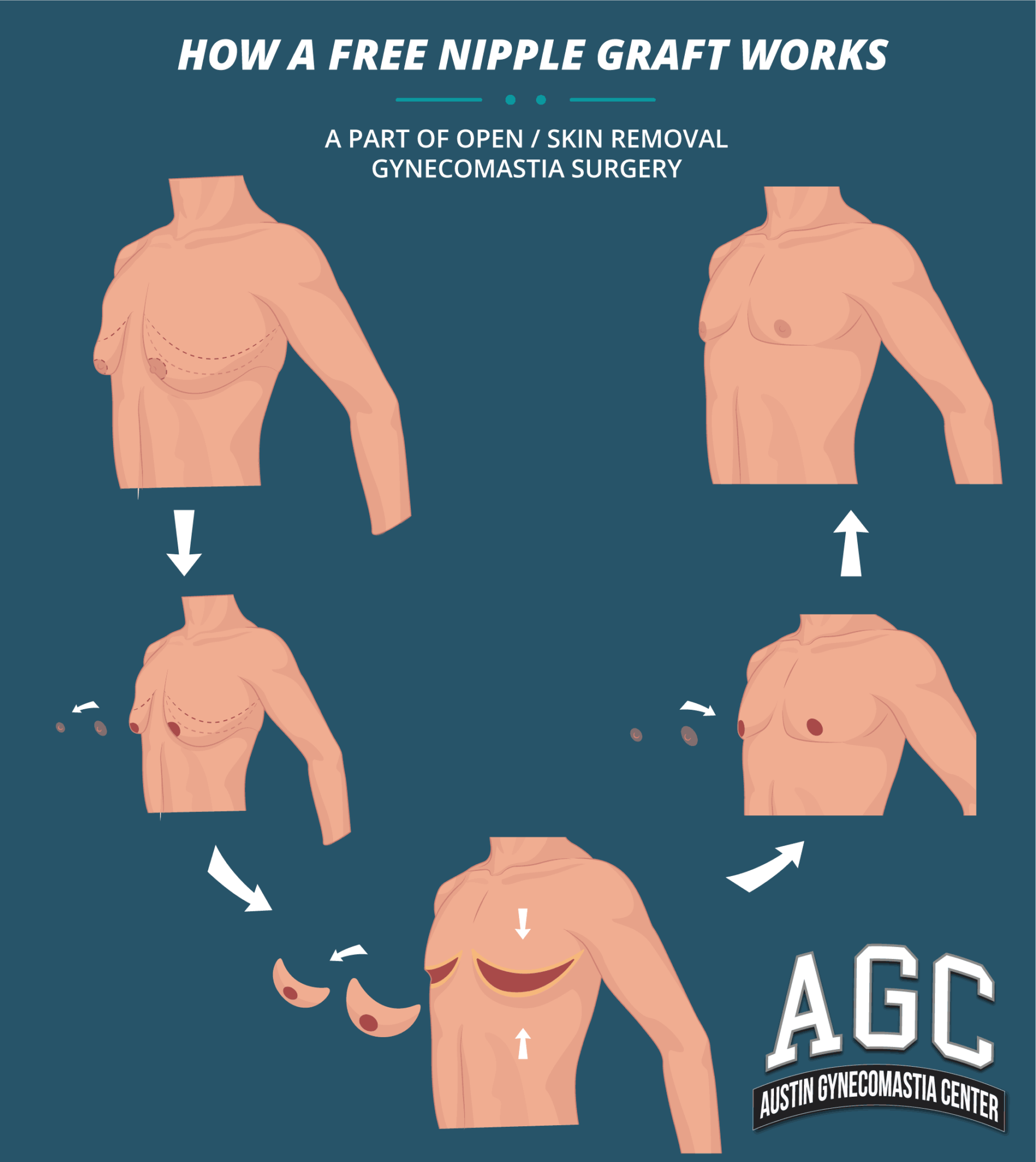 how a free nipple graft works, part of open / skin removal gynecomastia treatment