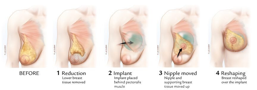Austin Breast Augmentation and Reduction Procedure: Surgery Steps - Robert Caridi, M.D. - Westlake Plastic Surgery