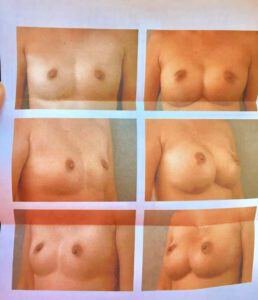 photos submitted by patient with symmastia - breasts that meet in the middle