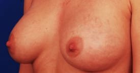 breast implant stretch marks