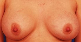 Austin breast implant stretch marks patient