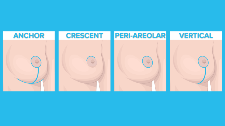 Austin breast lift explanation of the options for incisions