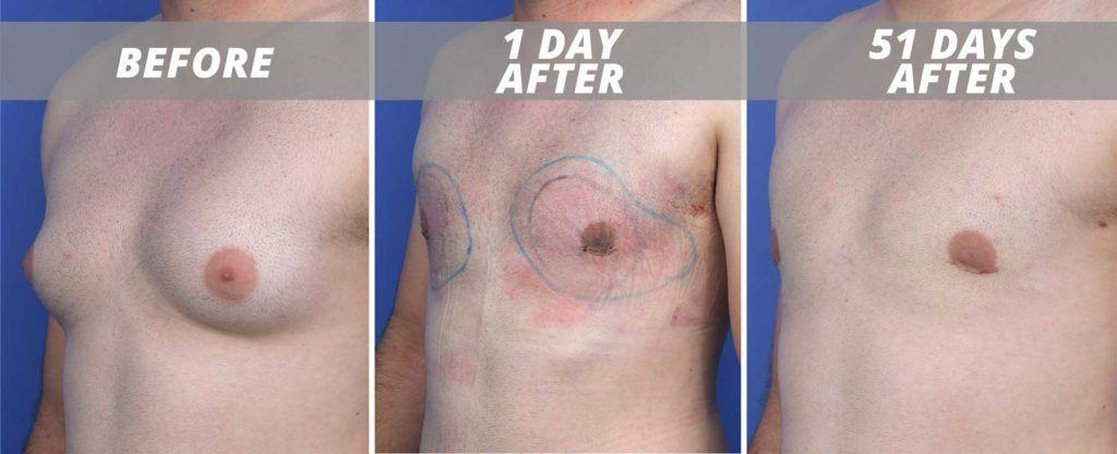 before and after male breast reduction
