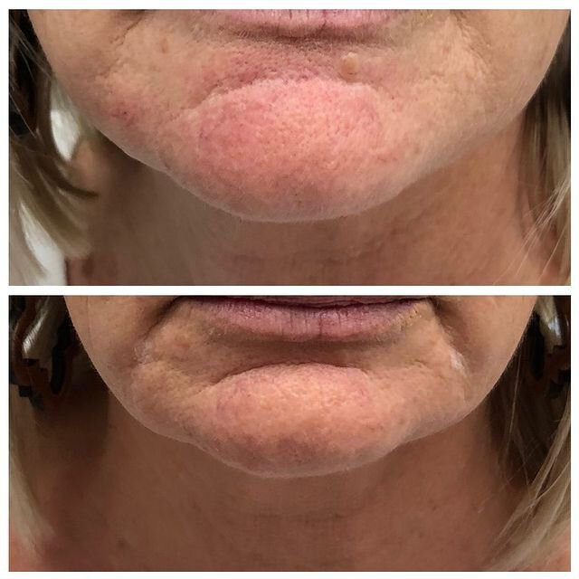 Non-Surgical Jawline Contouring Austin and Westlake