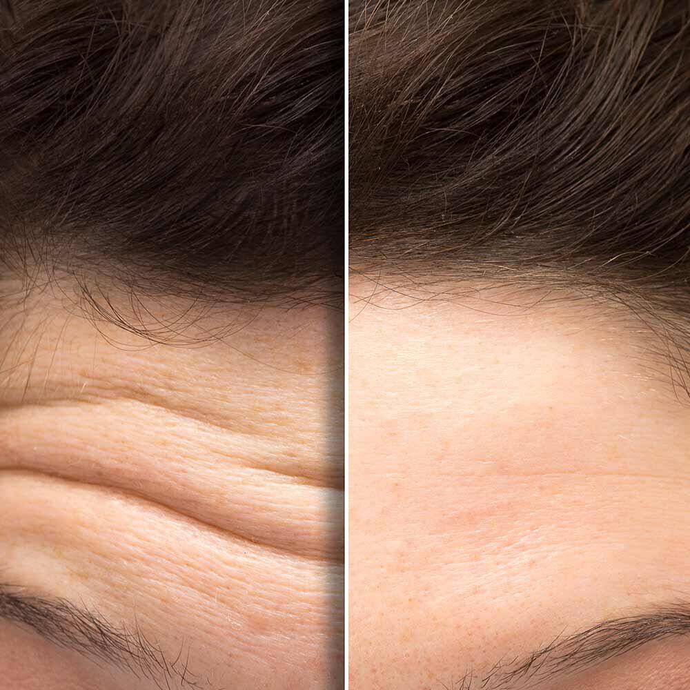 Austin Non-Surgical Cosmetic Treatments patient model before and after