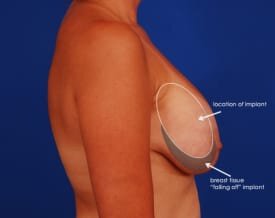 https://westlakeplasticsurgery.com/assets/img/feature/revision-center/thumbs_breast-falling-lateral_v3.jpg