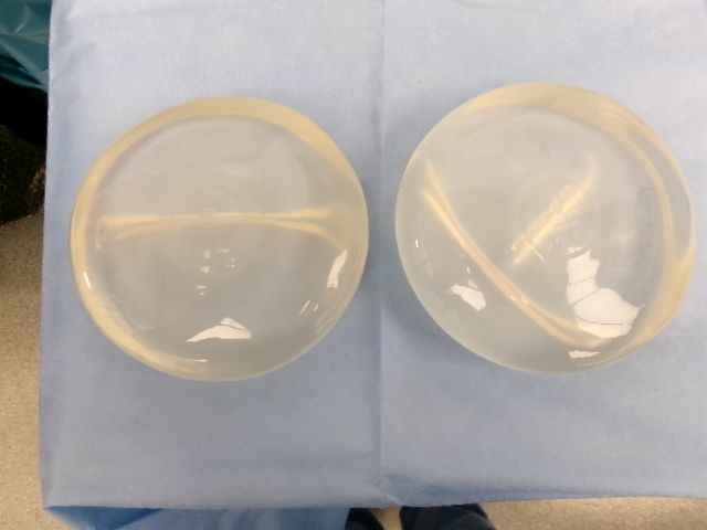 breast implant removal patient results