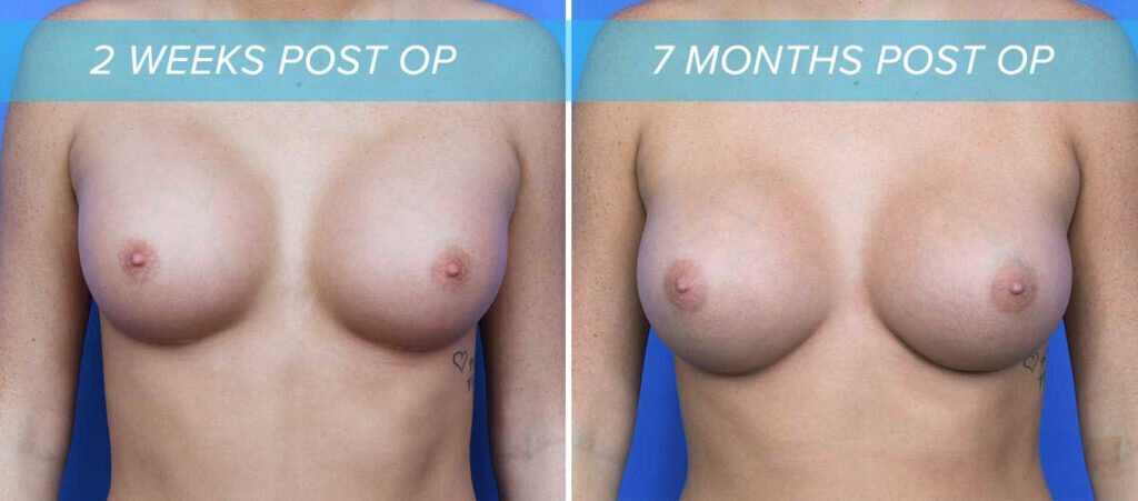 front view of breast implants settling from two weeks post op to 7 months post op