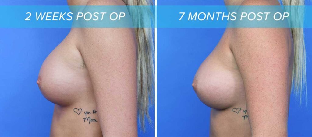 side view of breast implant settling showing 7 months after breast augmentation. results are due to the patient wearing a bra