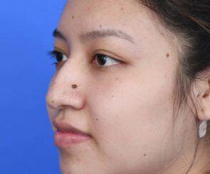 droopy nose tip that is more pronounced when smiling