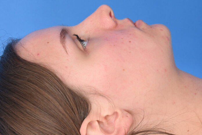 Austin neck lift before and after patient