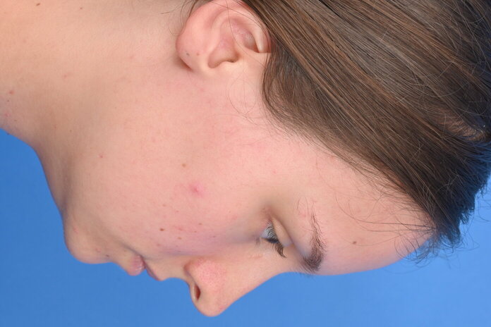 Austin neck lift before and after patient