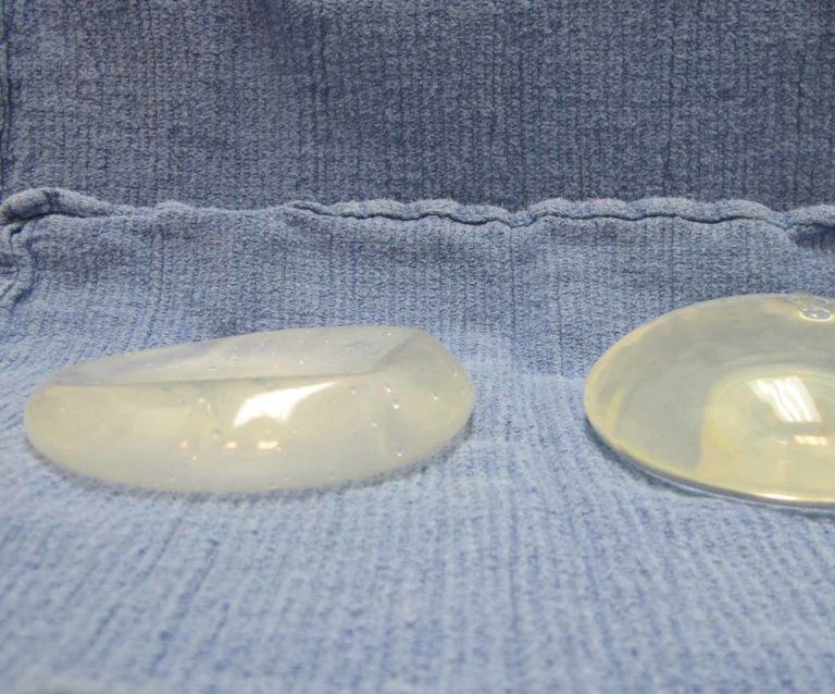 my saline breast implant deflated - now what - what do I do?