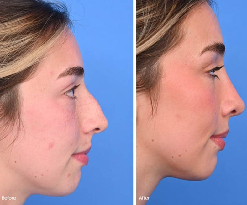 What You Need to Know About Nose Jobs and Fillers