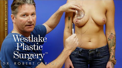 Breast Augmentation And Reduction In 90 Seconds