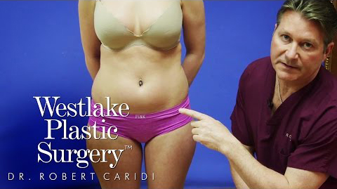 Everything You Should Know About Liposuction